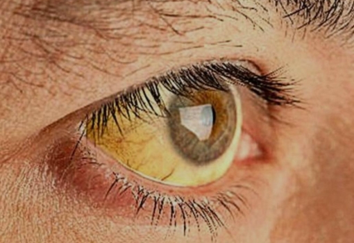 Color amarillo en los ojos